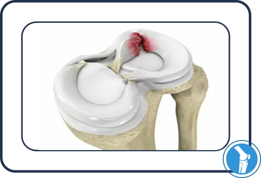 Пошкодження меніска