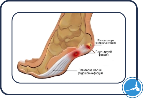 Плантарний фасциїт