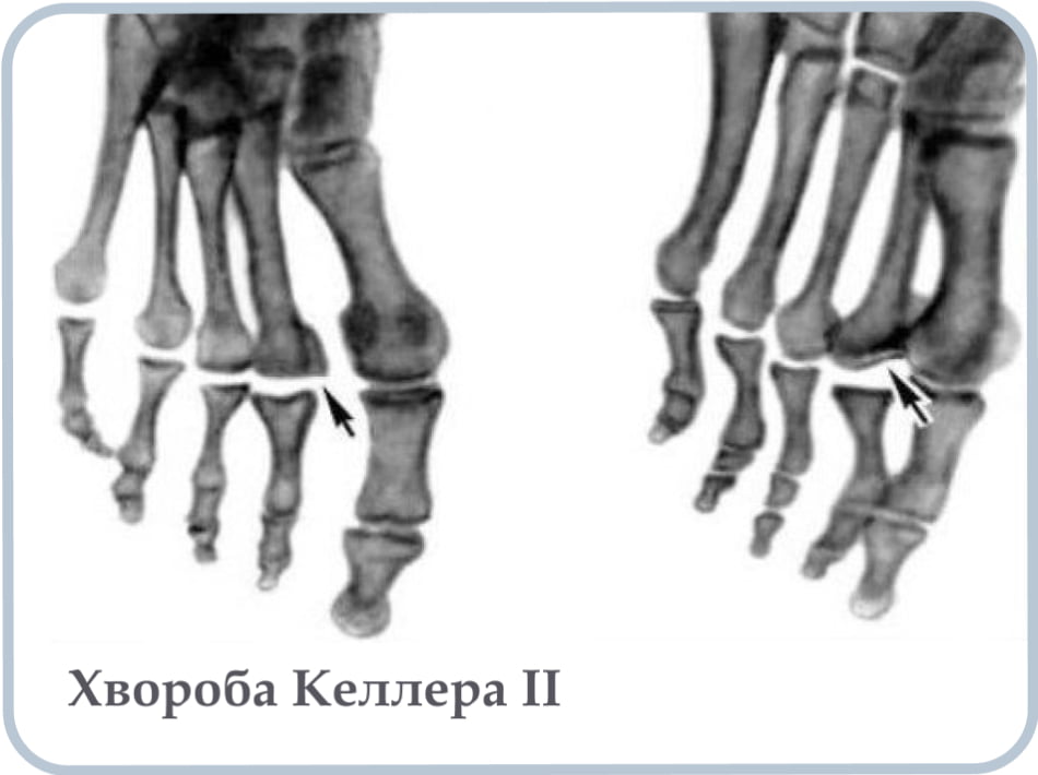 Хвороба Келлера